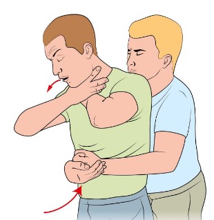 ¿Cómo salvar a alguien que se ahoga comiendo?: La maniobra de Heimlich. Imagen de El correo
