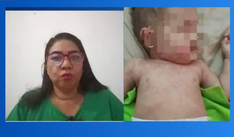 Madre expuso a su bebé de un año para que contrajera una bacteria en Zulia